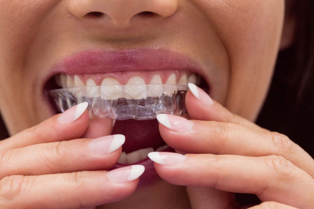 Close-up of a person inserting a clear dental aligner over their upper teeth, using both hands. The person has well-manicured nails and is smiling slightly, showing clean, straight teeth.