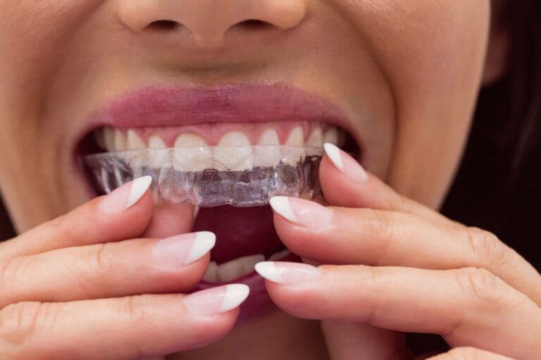Close-up of a person inserting a clear dental aligner over their upper teeth, using both hands. The person has well-manicured nails and is smiling slightly, showing clean, straight teeth.