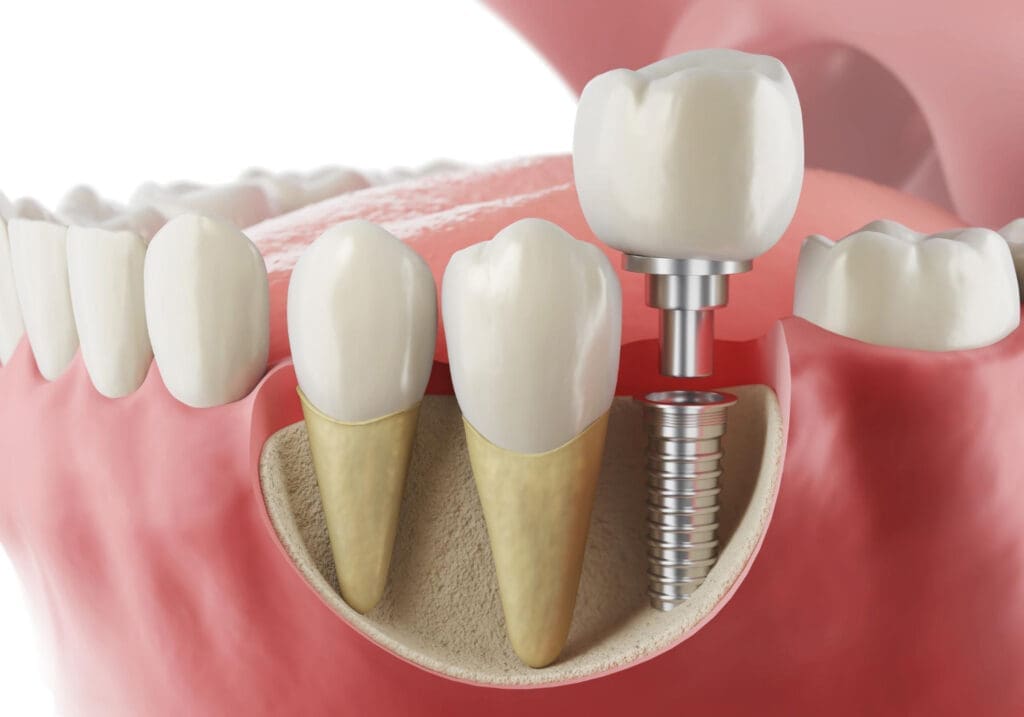Illustration showing a dental implant procedure: a metal screw is implanted into the jawbone, with a dental crown above it, next to natural teeth roots inside the gum and jaw.