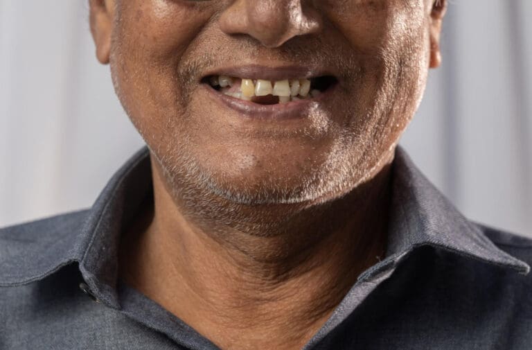 A close-up of an older man smiling, showing a gap between his upper front teeth. He has a short beard and is wearing a blue collared shirt. The background is out of focus.